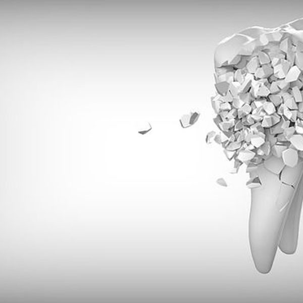 El auge del uso de implantes dentales